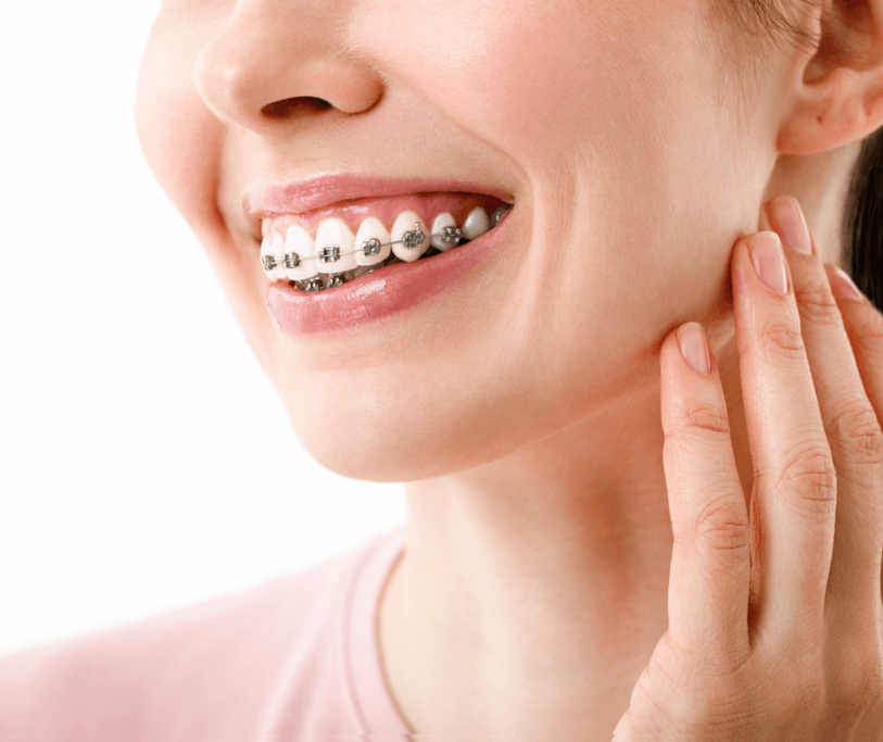 Metal Braces