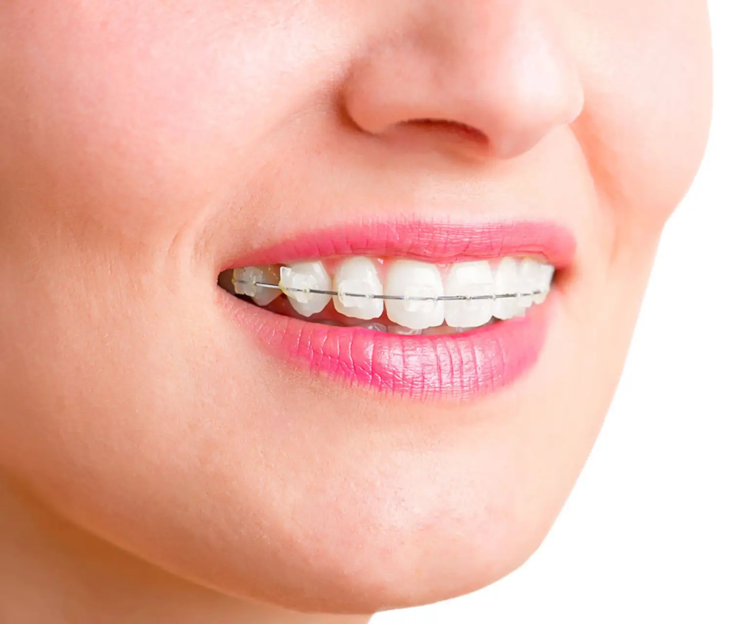 Clear Braces Appearance